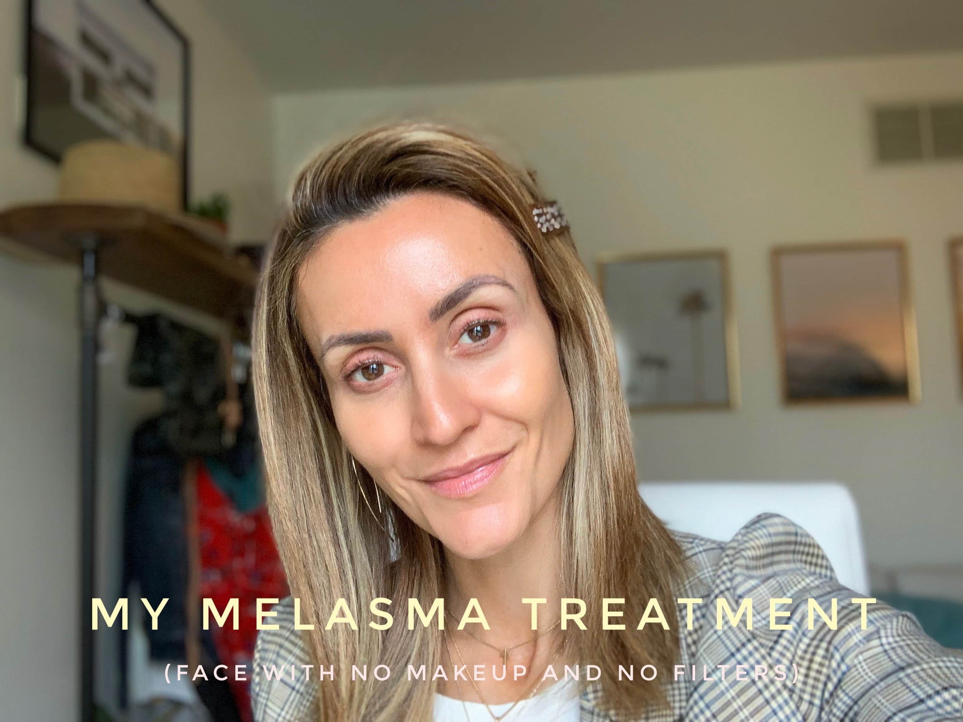 Karina Style Diaires | Melasma Treatment